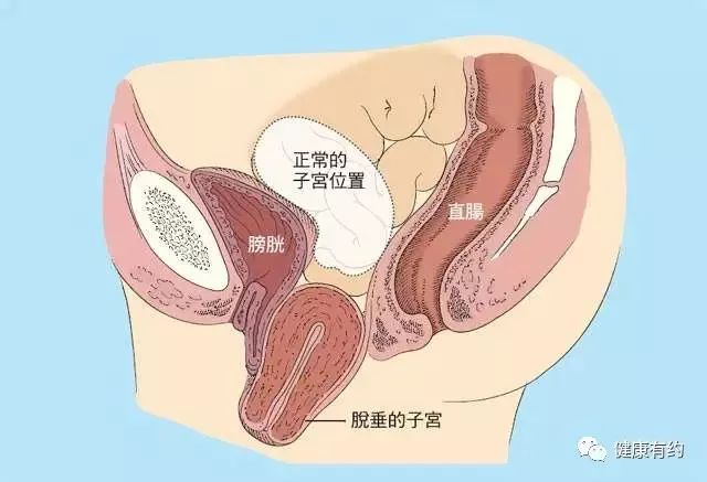 产后前壁膨出示意图 产后壁膨出图