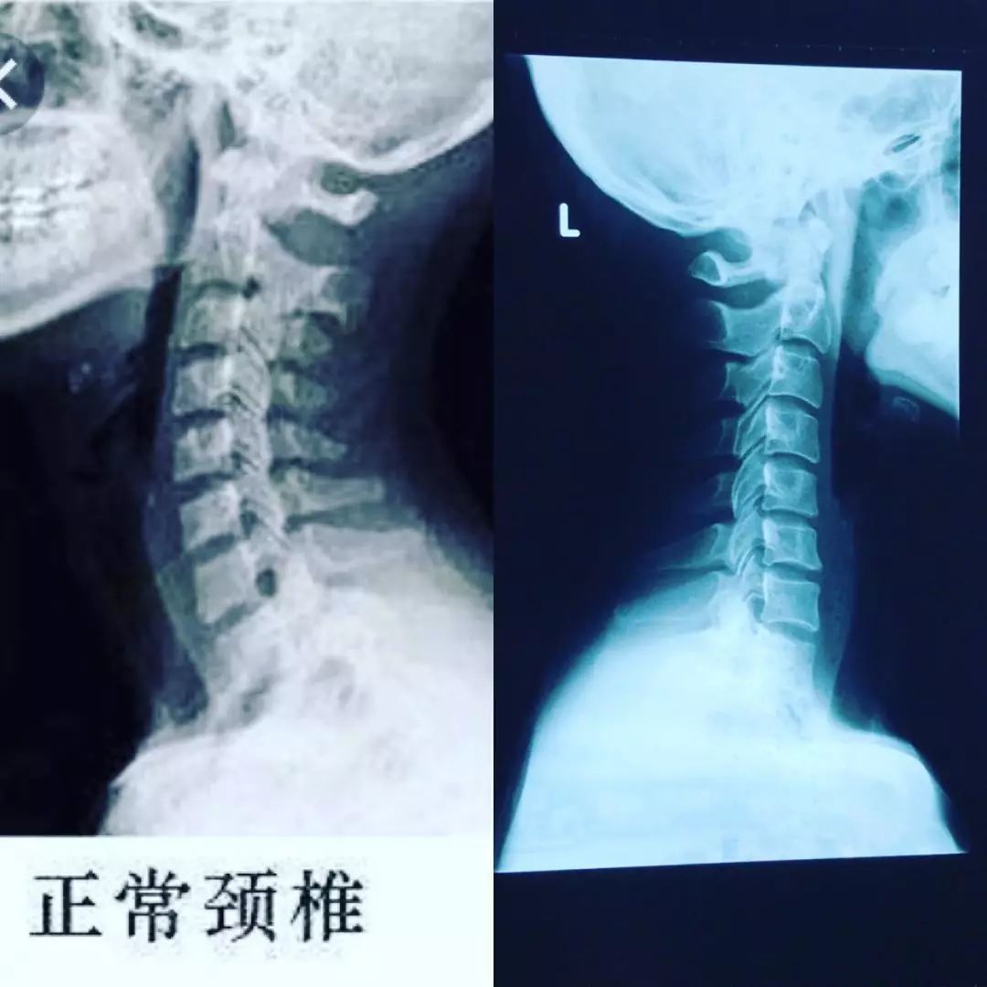 在六月份的时候,林夏薇曾上载过一张颈椎的x光片,当时她留言表示