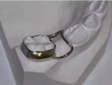 如过早丧失,应到医院及时佩戴间隙保持器以留住缺牙间隙,避免恒